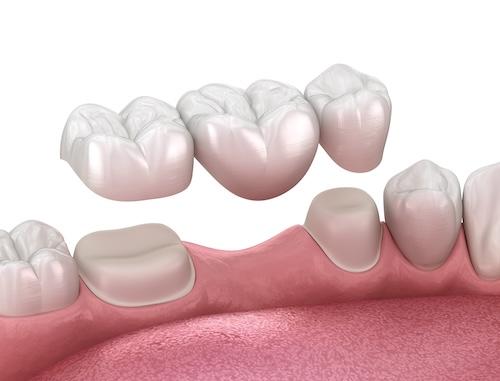 Dental Crowns and Bridges in Pampa, TX
