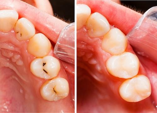 Before-and-after image showing a metal filling replaced with a natural-looking tooth-colored crown in Pampa, TX.