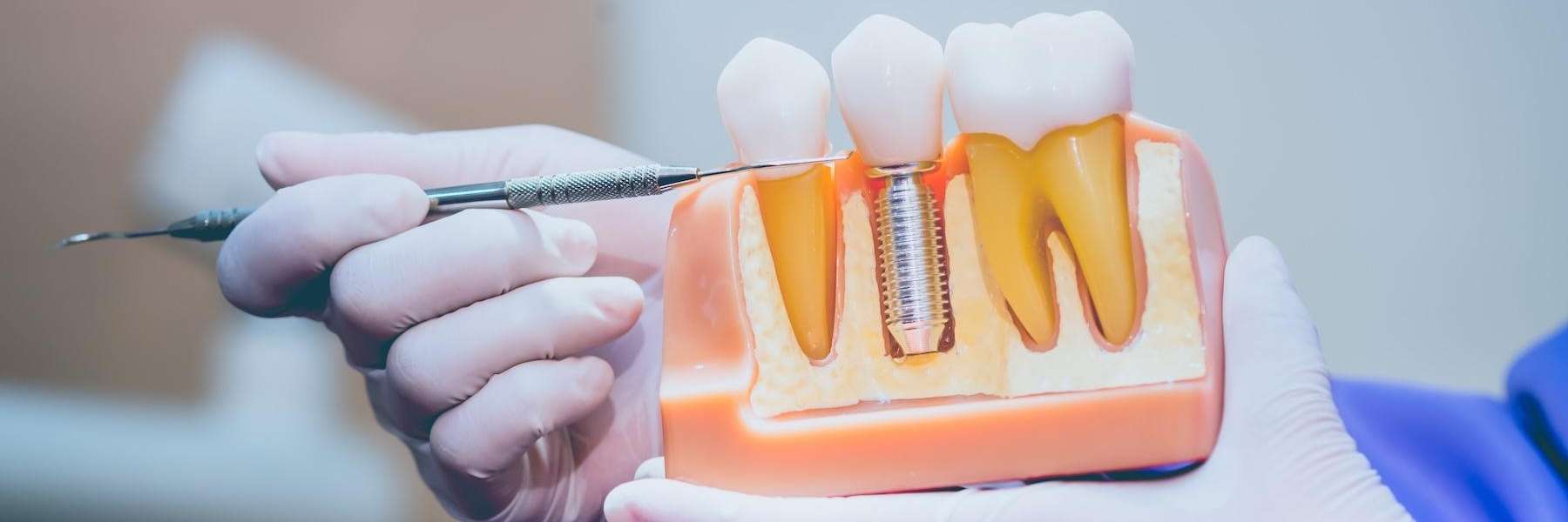 A mold illustration showing Dental implants in Pampa, TX
