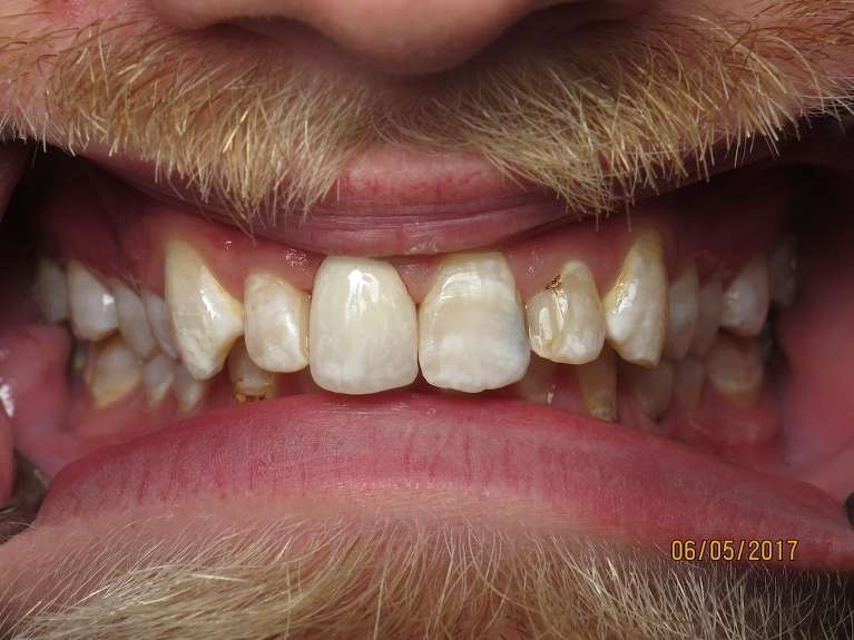 Broken-Front-Tooth-After-Image