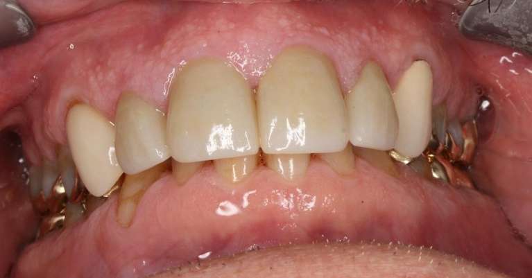 Ceramic-Crowns-After-Image