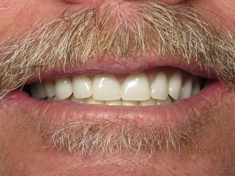 Dentures-After-Image