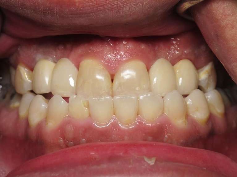 Implant-Bridge-After-Image