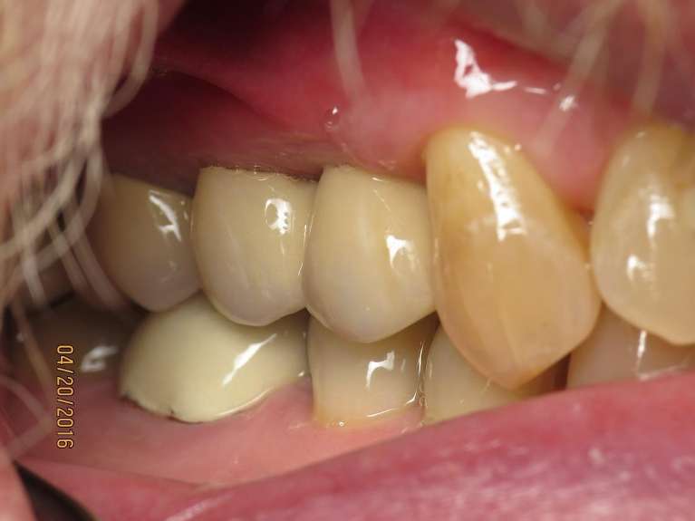 Implant-Crowns-After-Image