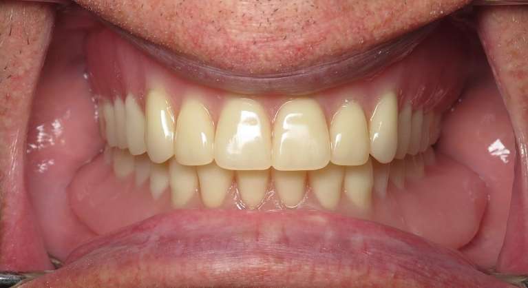 Implant-Dentures-After-Image