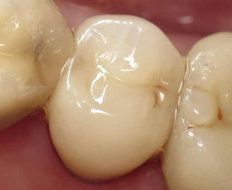 An image of Teeth after getting a Tooth Colored Crown in Pampa, TX