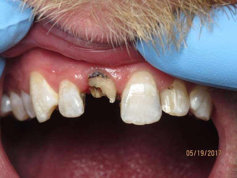 Broken-Front-Tooth-Before-Image