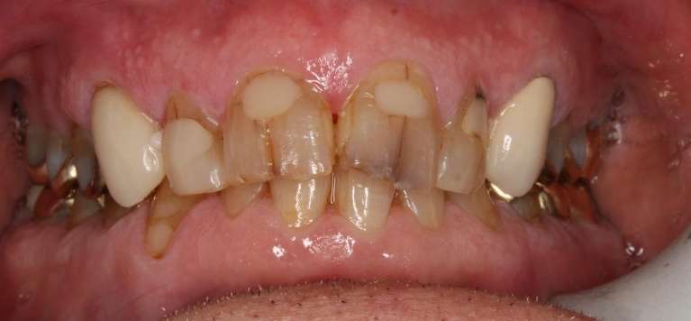 Ceramic-Crowns-Before-Image