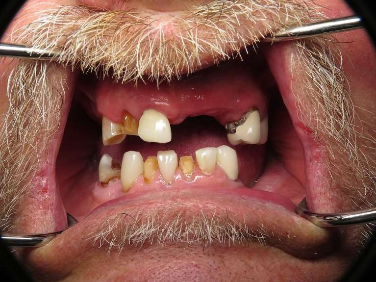 Dentures-Before-Image
