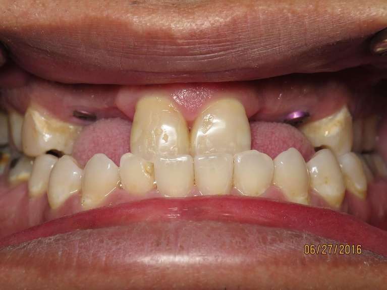 Implant-Bridge-Before-Image