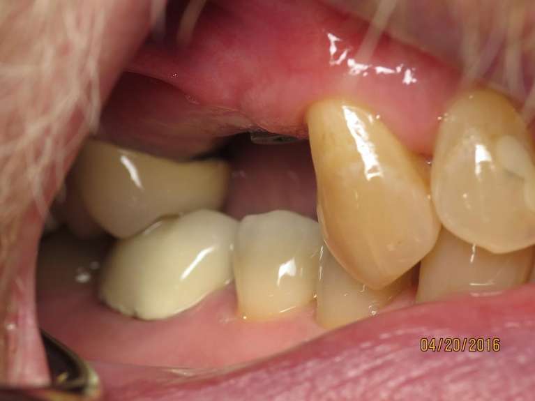 Implant-Crowns-Before-Image