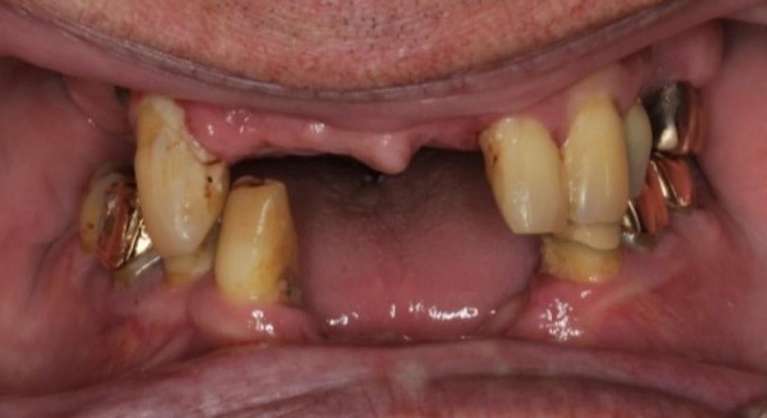 Implant-Dentures-Before-Image