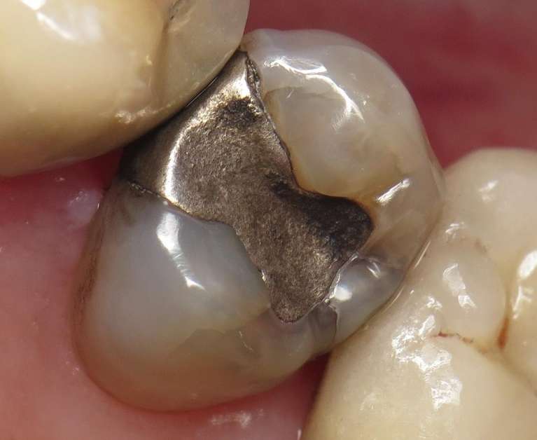An image of Teeth with a metal filling before getting a Tooth Colored Crown in Pampa, TX